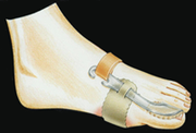 Bunion Night Splint