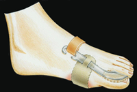 Bunion Night Splint